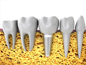 dental implants everett wa